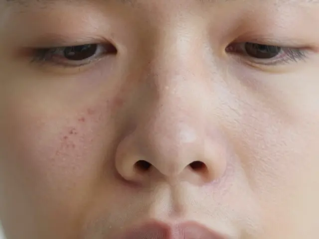 Jak odstranit komedony: efektivní metody, které skutečně fungují