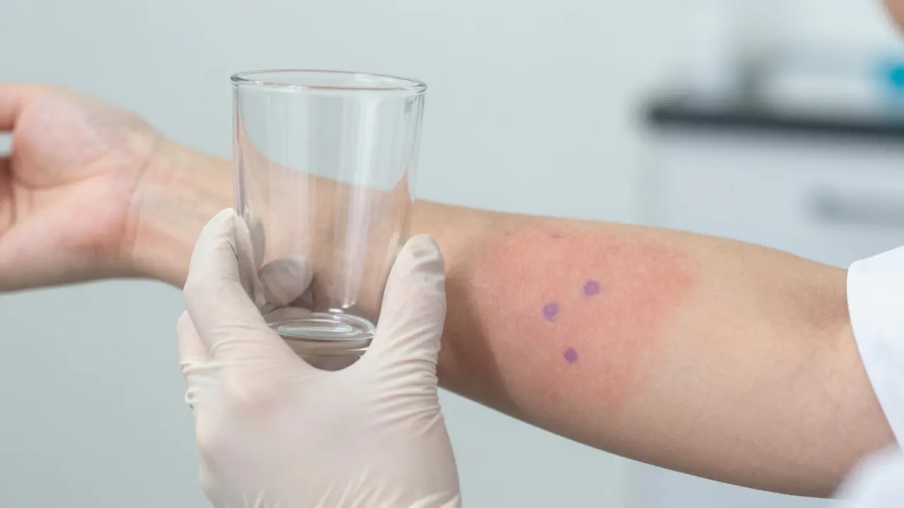 Test sklenicí na vyrážku, který ukazuje neblednoucí fialové skvrny